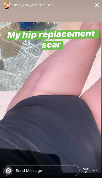 Emily Simpson Hip Scar 1