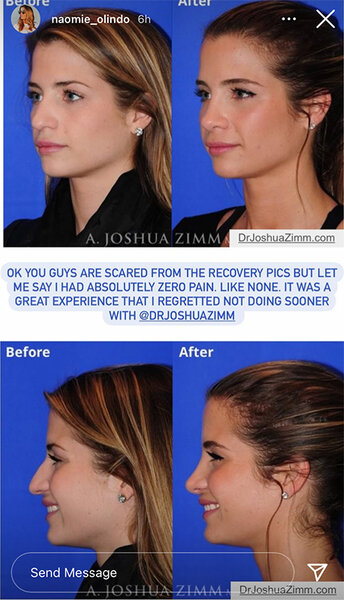 Naomie Olindo Nose Job Photos: Before & After Pics