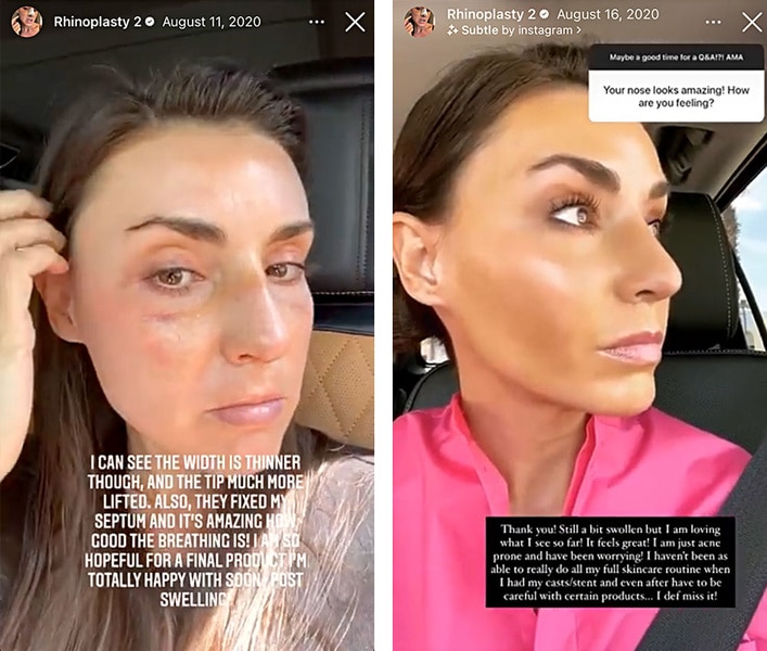 A series of Bronwyn Newport's Nose Job and the healing post operation